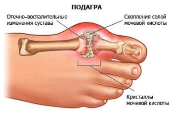 болезни суставов ног