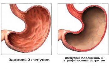 атрофический гастрит