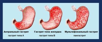 Helicobacter pylori