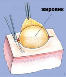 Удаление жировика в домашних условиях Удаление жировика в домашних условиях