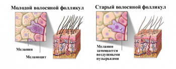 причины ранней седины