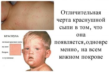 признаки краснухи