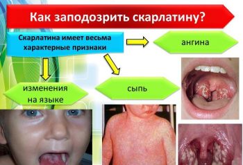 как заподозрить скарлатину