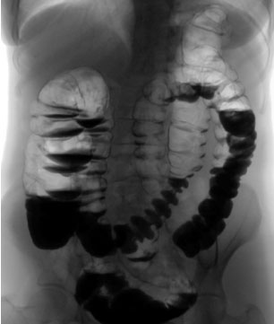 Пассаж кишки. Непроходимость Толстого кишечника рентген. Толстокишечная непроходимость рентген Пассаж бария. Инвагинация кишечника рентген. Инвагинация толстой кишки рентген.