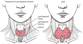 щитовидная железа норма и зоб