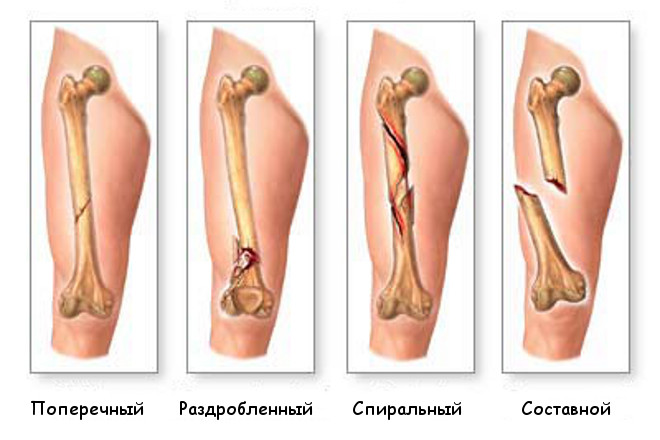 Как выглядит перелом ноги кости Переломы виды переломов первая помощь Мой семейный врач