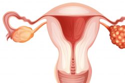 Рак яичников: симптомы у женщин, современные методы лечения