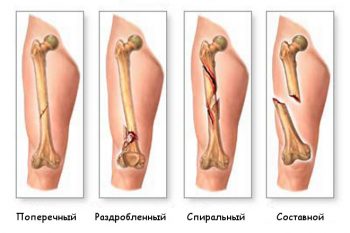 виды переломов
