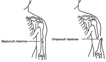 Переломы виды переломов первая помощь