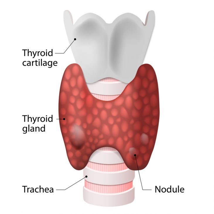 Многоузловой зоб на фоне хронического тиреоидита щитовидной железы