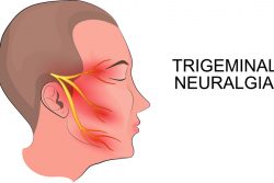 Невралгия тройничного нерва — симптомы, лечение