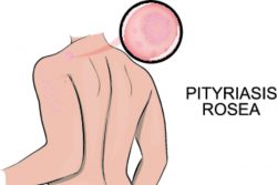 Розовый лишай — симптомы и лечение
