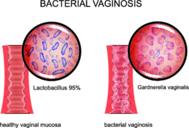 Гарднерелла у женщин фото