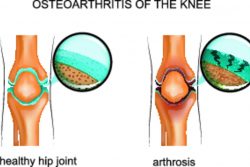 Остеоартроз коленного сустава: причины, симптомы, лечение и профилактика