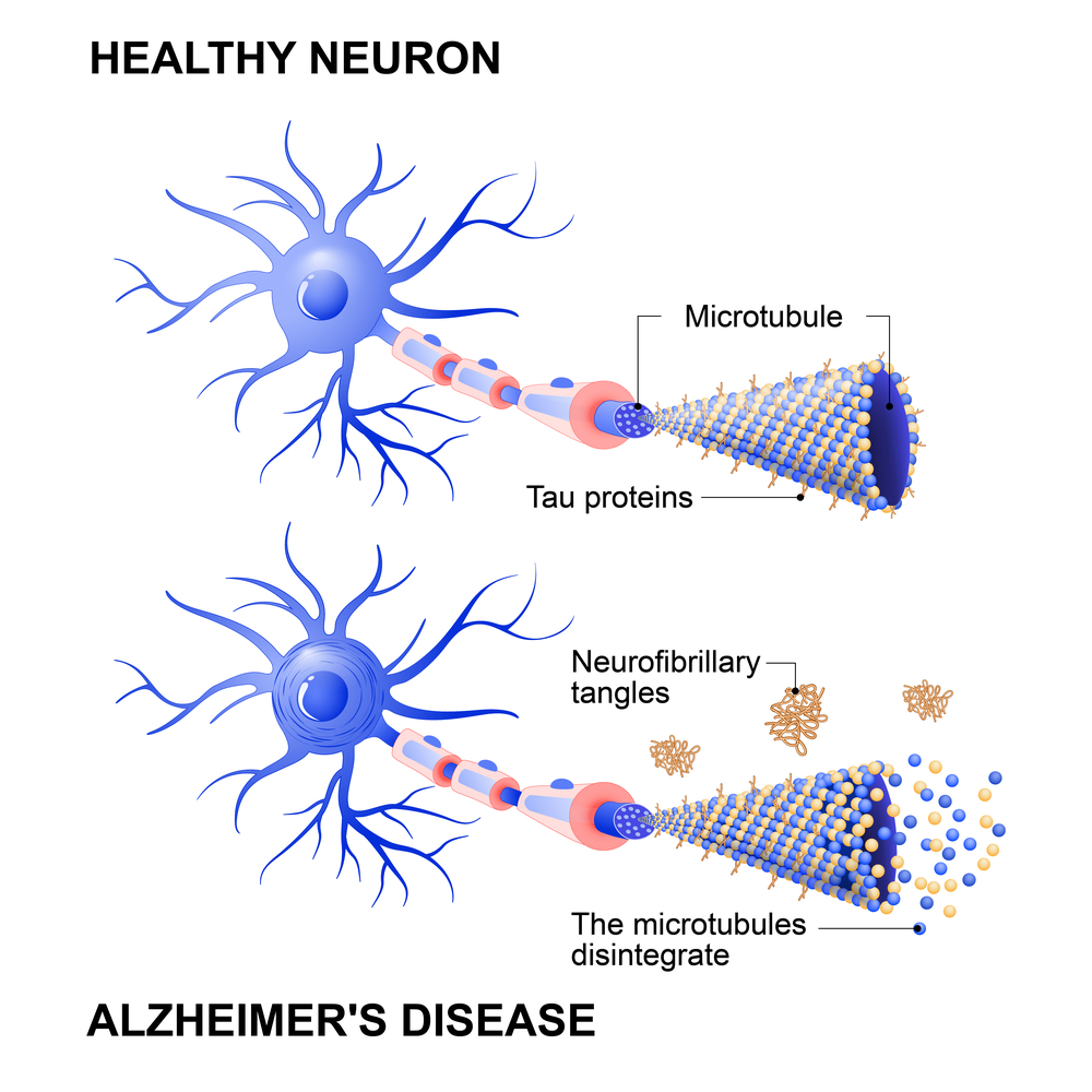 Тау протеин болезнь Альцгеймера