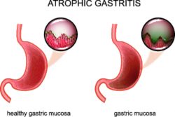Атрофический гастрит – симптомы, диагностика и лечение