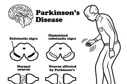 Болезнь Паркинсона: симптомы, лечение