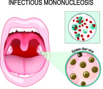Инфекционный мононуклеоз фото горла