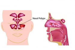 Полипы в носу: причины, симптомы и лечение