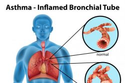 Бронхиальная астма: причины, симптомы, методы диагностики