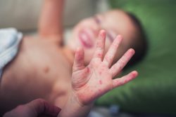 Краснуха у ребенка: симптомы и лечение