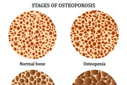Диета при остеопорозе