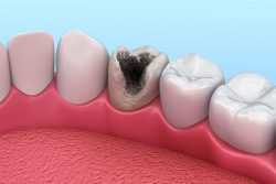 Почему выпадают пломбы из зубов