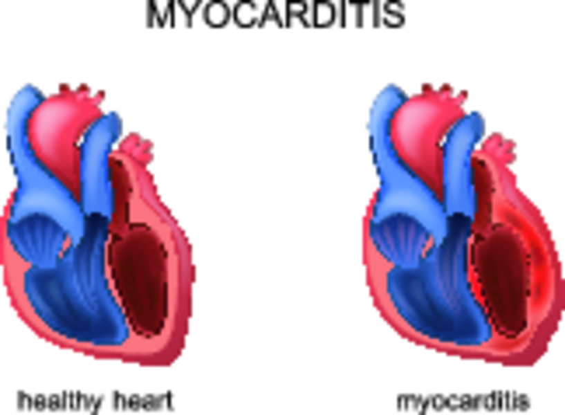Миокардит картинки для презентации