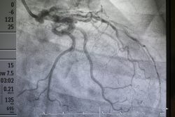Коронарография сосудов сердца: суть метода, показания, противопоказания