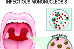 Инфекционный мононуклеоз у детей: симптомы и лечение