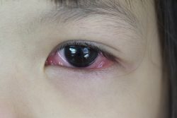 Аллергический конъюнктивит у ребенка: симптомы и лечение