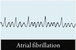 Мерцательная аритмия: симптомы и лечение