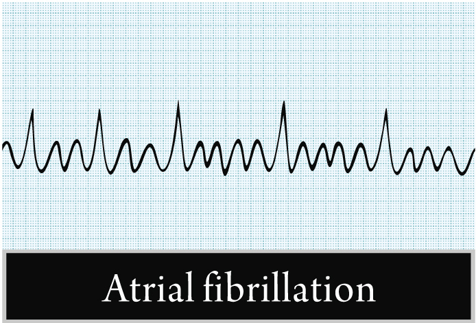 Описание экг при мерцательной аритмии