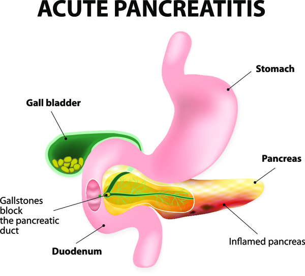 Найз при остром панкреатите