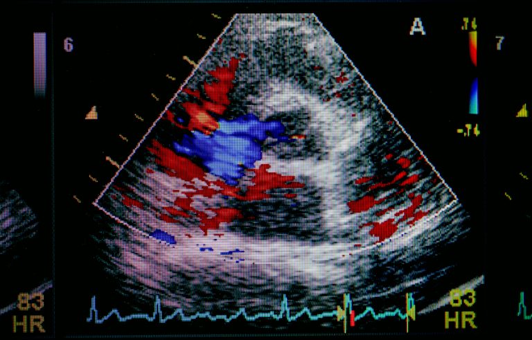 Как делают эхокардиографию сердца женщинам фото