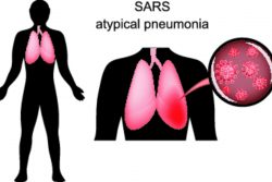 Атипичная пневмония: симптомы и лечение