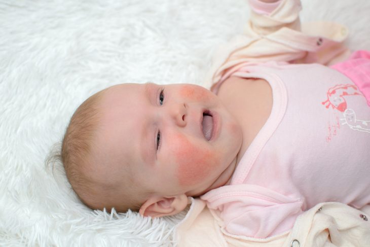 Шершавая кожа на лице младенца