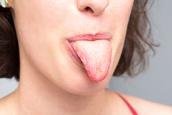 Болезни языка – симптомы, причины, лечение