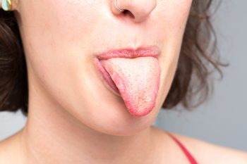 Болезни языка – симптомы, причины, лечение