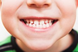 Прикус у детей: что делает зубы ребенка кривыми?