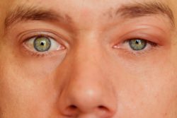 Воспаления века глаза — как лечить