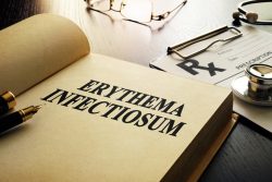 Эритема инфекционная: почему возникает и как проявляется