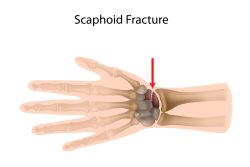 Перелом ладьевидной кости: механизм травмы, клинические проявления