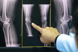 Рентген коленного сустава: показания и противопоказания, норма и патология