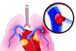 Тромбоэмболия легочной артерии: симптомы, неотложная помощь