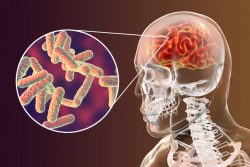 Туберкулез головного мозга: чем проявляется, как лечить, прогноз