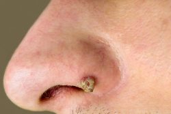 Папиллома в носу: симптомы, методы лечения