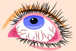 Воспаленные глаза: причины, симптомы