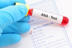 Анализ крови на антинуклеарные антитела: подготовка к исследованию, расшифровка