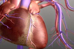 Атеросклеротический кардиосклероз: особенности течения и лечения